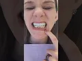 Custom GOLD Dental implants jaximplantsanddentures