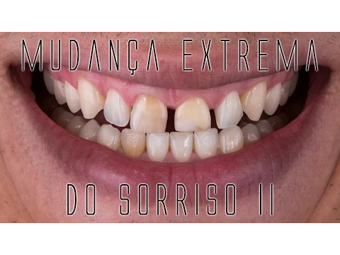 Download MP3 Mudança extrema do sorriso II: Os bastidores das facetas e lentes de contato dentais