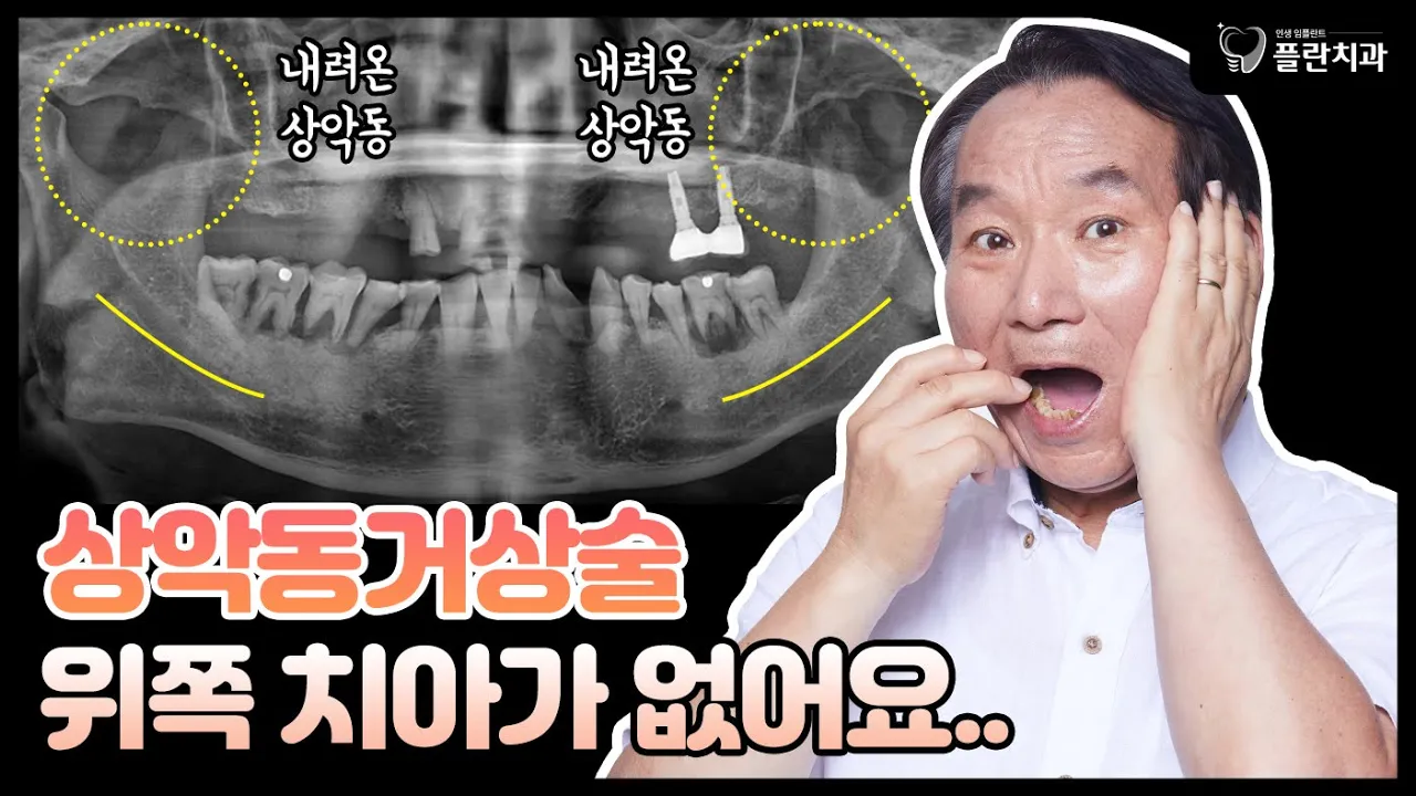 [상악동거상술] 위쪽 치아가 없어요..