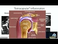 Download Lagu Polymyalgia Rheumatica: What has changed since 1957?