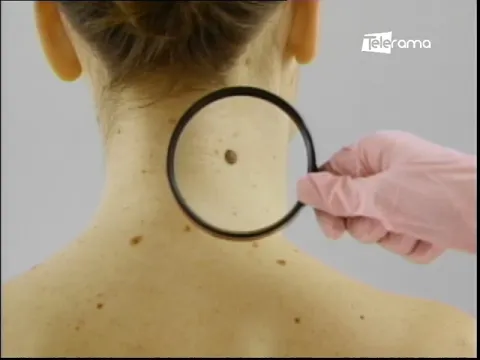Causas del melanoma
