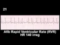 ECG Rhythm Recognition Practice - Test 1