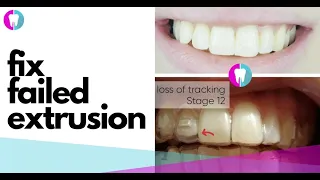 Case Study Tracking troubleshooting extrusion correction Clear Aligner incisal gap