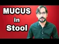 Mucus in Stool Causes of Mucus in Stool