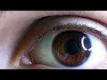 Project S2021 25 Early detection device for diabetic retinopathy using artificial intelligence