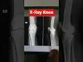 Digital X-Ray Knee Joint