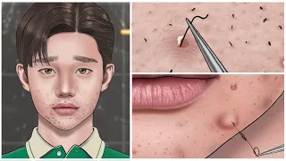 [ASMR] 대리만족! 속 시원한 인그로운 헤어 뽑기 / Satisfactory ingrown hair removal animation