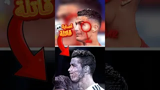 اصابة كادت أن تنهي مسيرة رونالدو مع ريال مدريد أسوأ اصابة Shorts 