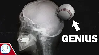 How a Baseball Injury Made A Genius Savant Syndrome