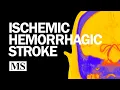 Introduction to Ischemic and Hemorrhagic Stroke 2025