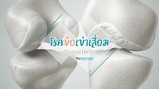 สาเหตุหลักที่ทำให้เกิดข้อเข่าเสื่อมคืออะไร และมีปัจจัยอื่นใดบ้างที่ทำให้เกิดก่อนวัยอันควร