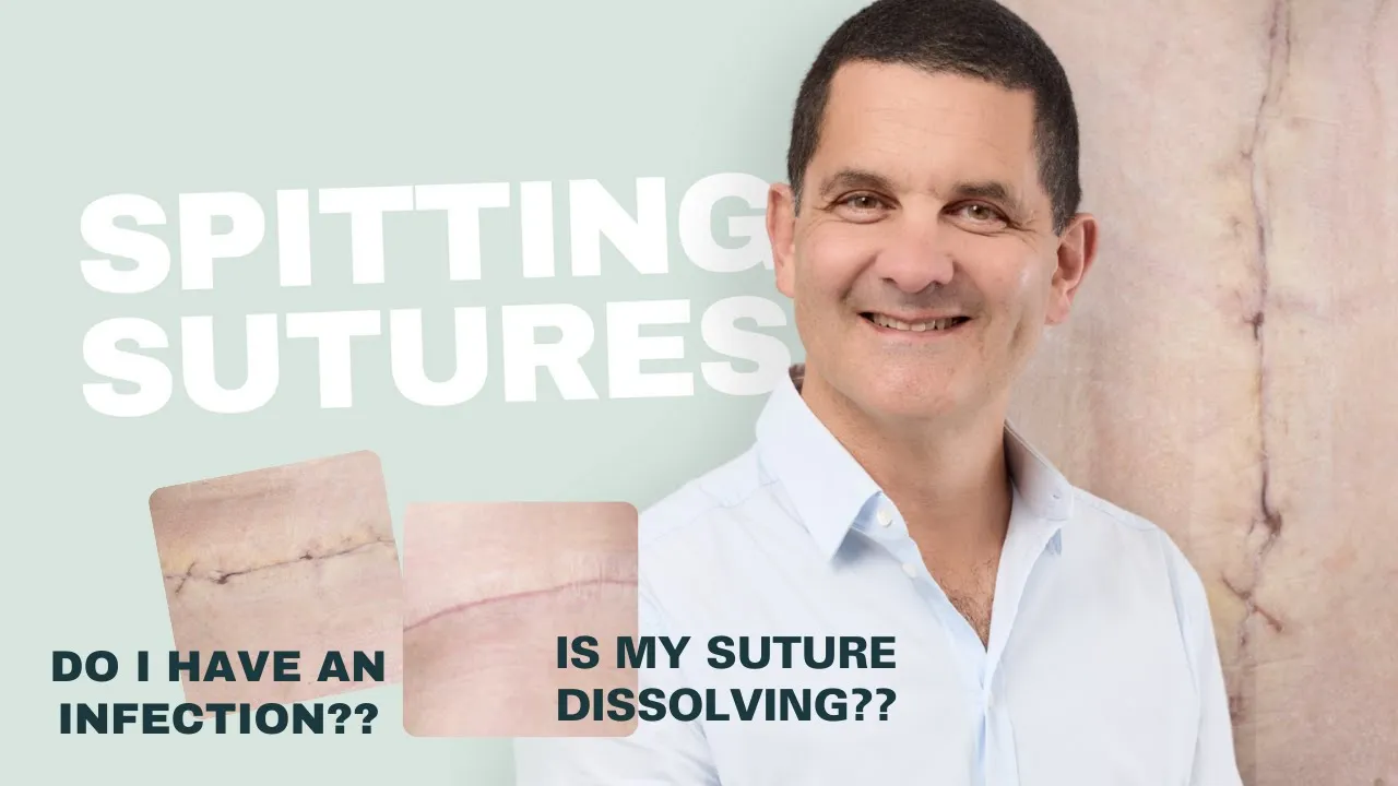 Spitting Sutures