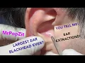 Giant ear blackheads extracted There s one triple pore one pocket - difficulty level-Wizard