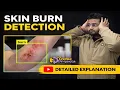Bed Sores Stage Classification using Machine Learning Image Processing Projects