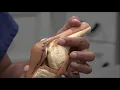 Dr Manish Patel explains the Jiffy Knee vs how other surgeons do the surgery