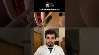 عملیات کیسه صفرا دندنها