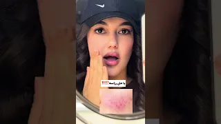 چجوری از شر جوش و جای جوش خلاص بشم  دندنها