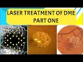 LASER TREATMENT for DIABETIC MACULAR EDEMA - PART 1 focal grid modified grid laser and more
