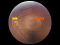 Optic Disc Detection from fundus image