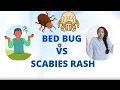 Bed Bug vs Scabies Rashes - Know the differences