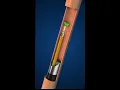 Kidney Stones Demolished Laser Lithotripsy