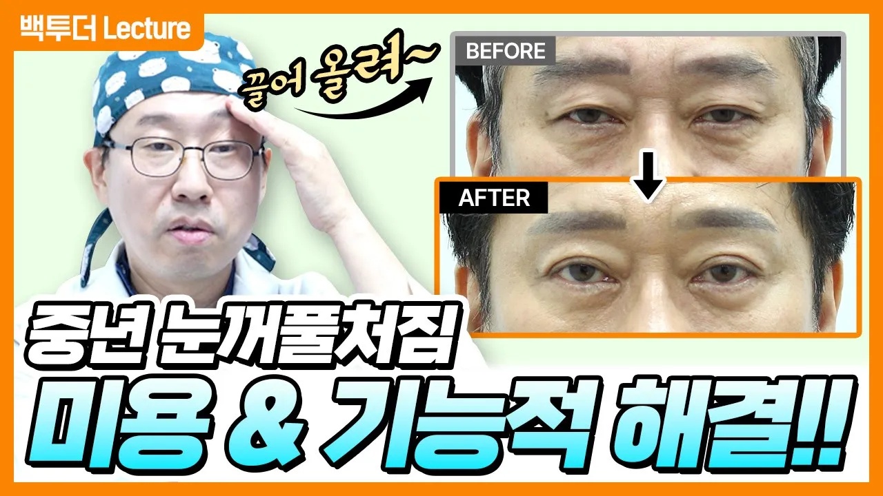 눈매는 그대로, 처짐 개선! 인상을 부드럽게! 50대 자연스러운 상·하안검 수술 공개