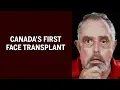 The story behind Canada s first face transplant