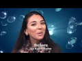 Restylane Lyft lips A