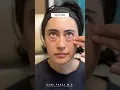 Selfie 4 Months After Trifecta Lift Beverly Hills CA Lower Blepharoplasty for Under Eye Bags