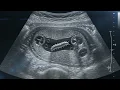 Stomach scan Ultrasound prank on kids