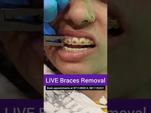 Download MP3 LIVE Braces Removal- Debonding; Dr. Srishti Bhatia #braces #teeth