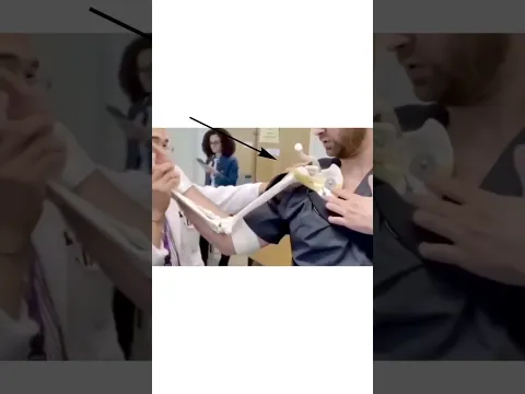 Así se corrige una Luxación en el Hombro🦴