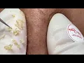 371 Blackheads Acne treatment 2021