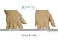 Download Lagu Hand Rejuvenation NYC | Radiesse Q \u0026 A with Dr  Bruce Katz