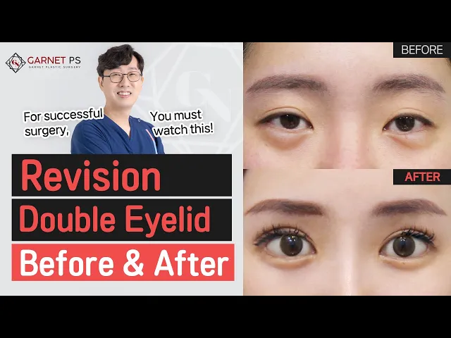 What is the "Sausage eye?"│Check out the Before & After revision Double Eyelid Surgery💨