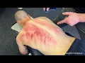 *Gua Sha ASMR* Compilatie! 30 minuten aan scraping, Kerokan en toxines uitgebracht!