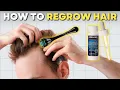 How to Microneedle with Minoxidil for Best Hair Results