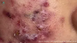 Download Big Cystic Acne Blackheads Extraction Blackheads \u0026 Milia, Whiteheads Removal Pimple Popping MP3