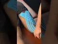 Taping For Hamstring Strain