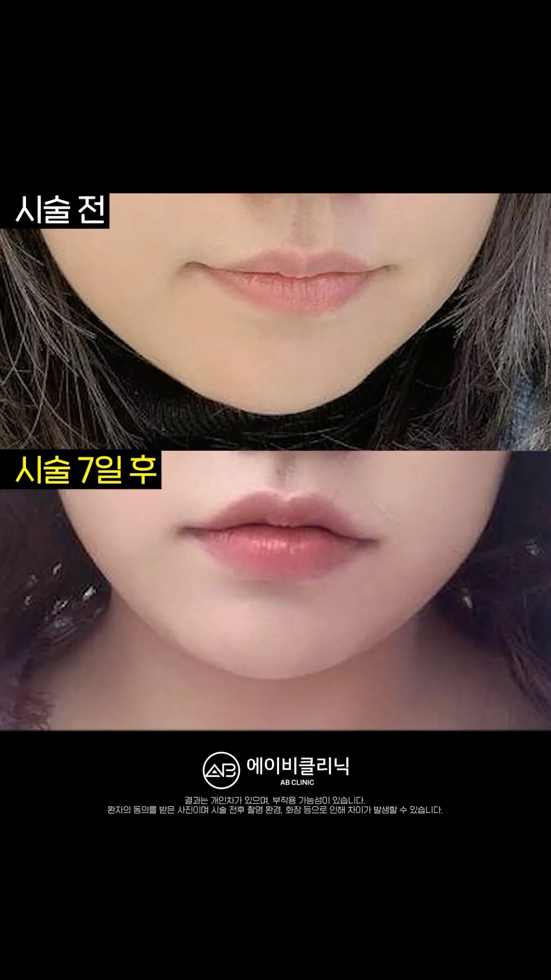 장원영 되기 1일차💗 ft. 입술필러