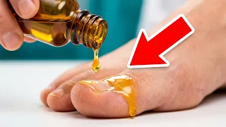 Use THIS and Nail Fungus Will Disappear Forever 💥 (Incredibly Fast) 🤯