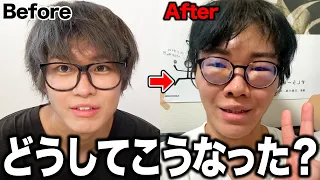 【ダウンタイム】植毛した男の1週間に密着したら、、、