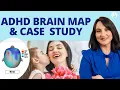 AD Brain Map and Case Study Dr Roseann Capanna-Hodge Podcast