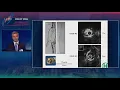 Both Are Wrong Combination Therapy With Vessel Preparation Plus