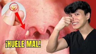 Si tienes Mal Aliento y NO sabes por qué… pueden ser TONSILOLITOS