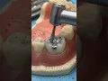 Removing Old Filling For Root Canal Treatment