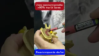  ทำไมการนอนหมอนสูงถึงไม่ดีสำหรับคนที่มีอาการปวดคอจากหมอนรองกระดูกเสื่อม 