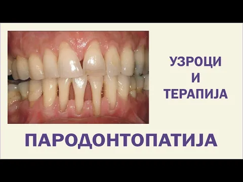 Parodontopatija - uzroci i lečenje Prof. Čupić