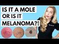 Is It A Mole or Melanoma This Might Save Your Life Dermatologist Tips