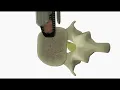 Lateral interbody fusion